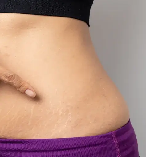 Stretch Mark Reduction 1