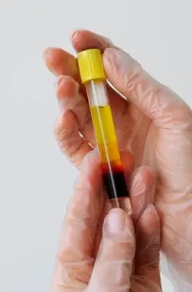 Platelet-rich plasma 4