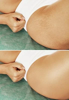 Stretch Mark Reduction-1