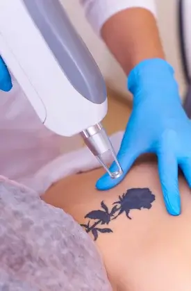 Tattoo Removal 2