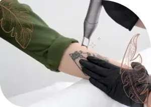 Tattoo Removal second img