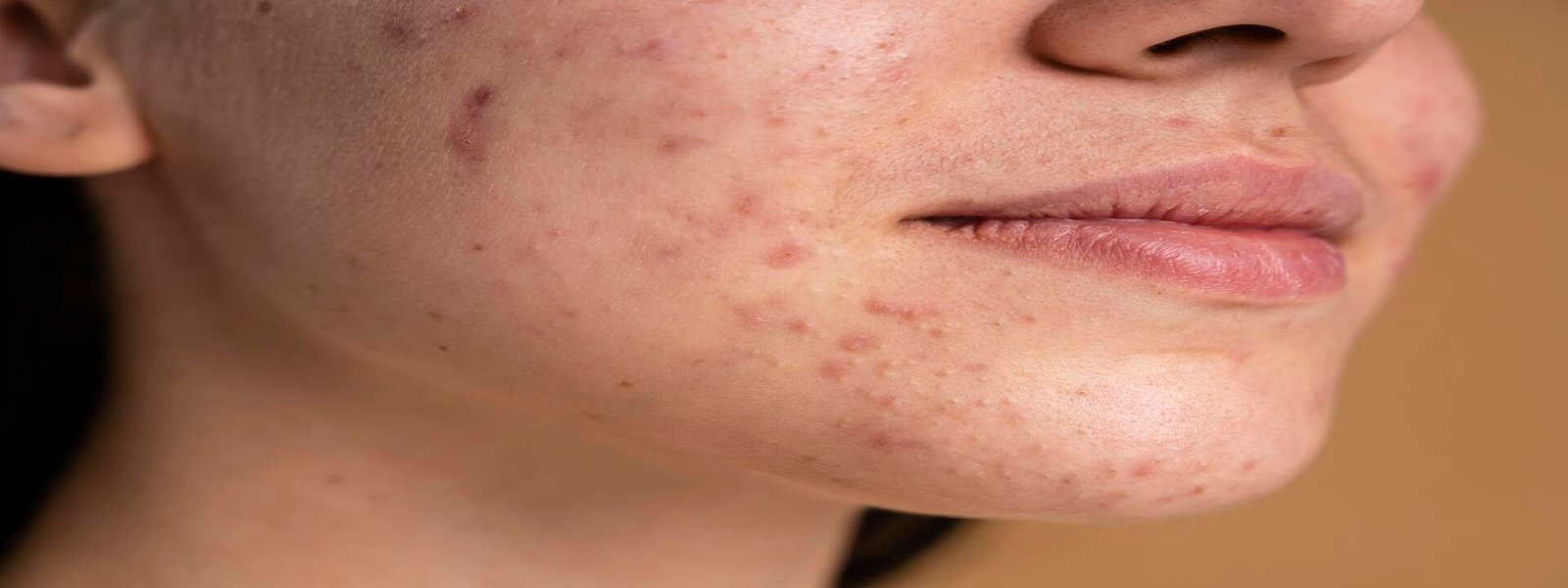 Close-up of a woman's face with visible acne and scars on her cheek