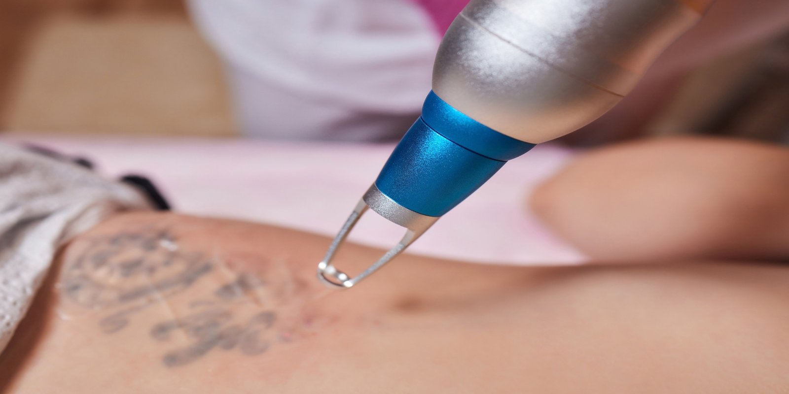 Close-up of a laser device being used for tattoo removal on a person's skin, highlighting the precision of the process.