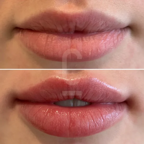 Lip-Enhancement-Female-1