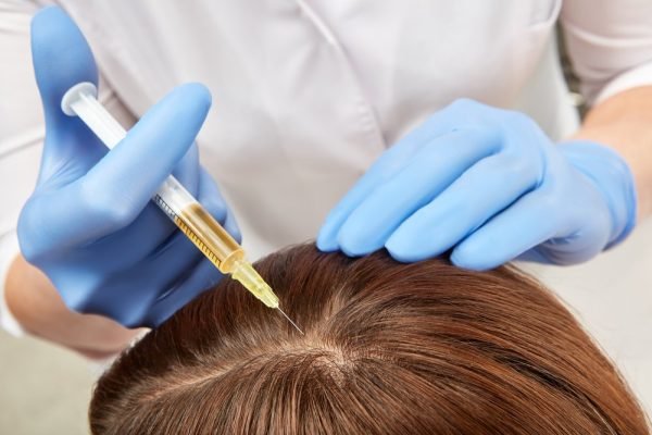 wellnesshair-restoration-prp-what-are-the-side-effects-of-a-prp-injection
